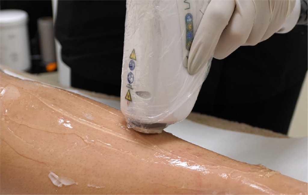 operator performs laser hair removal treatment