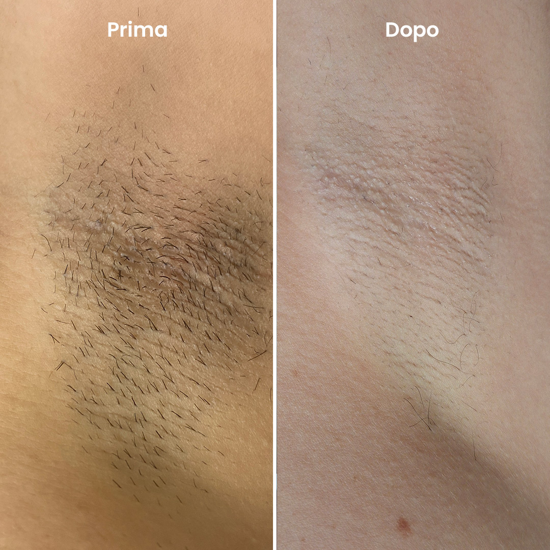 ilmegliodite-myolaser-epilazione-laser-prima-dopo-ascelle