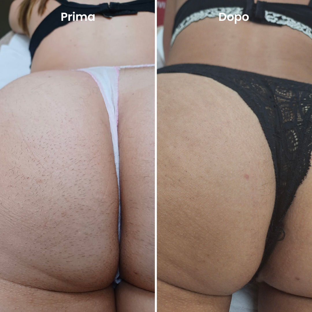 ilmegliodite-myolaser-epilazione-laser-prima-dopo-glutei