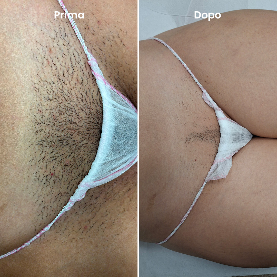 ilmegliodite-myolaser-epilazione-laser-prima-dopo-inguine