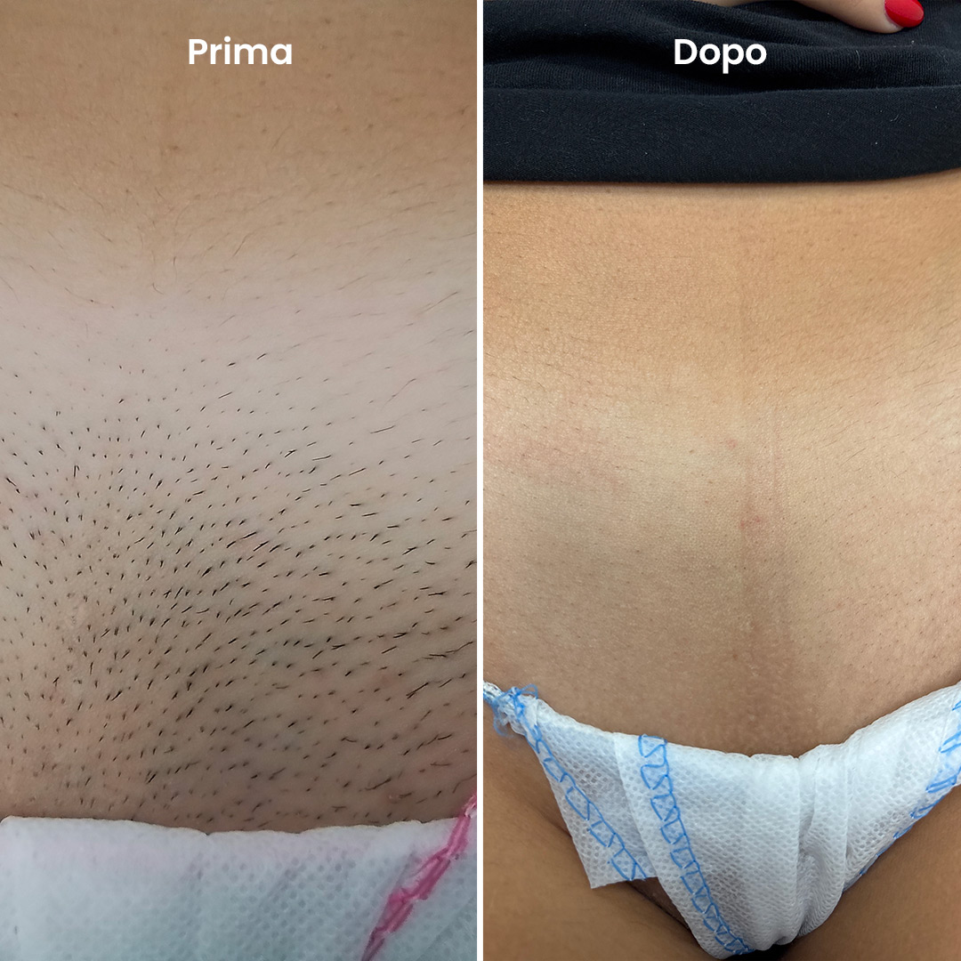 ilmegliodite-myolaser-epilazione-laser-prima-dopo-pube