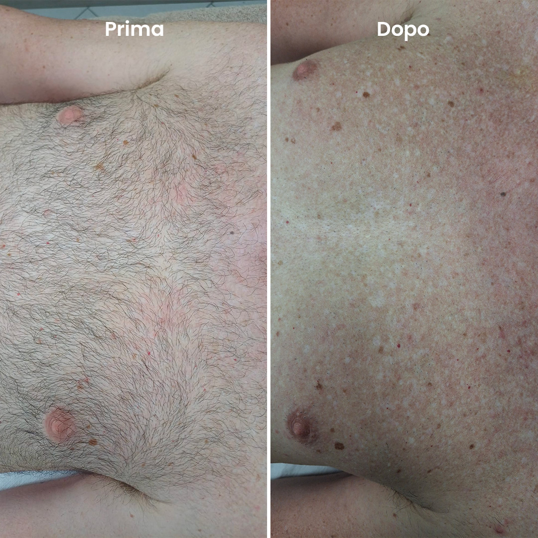 ilmegliodite-myolaser-epilazione-laser-prima-dopo-uomo
